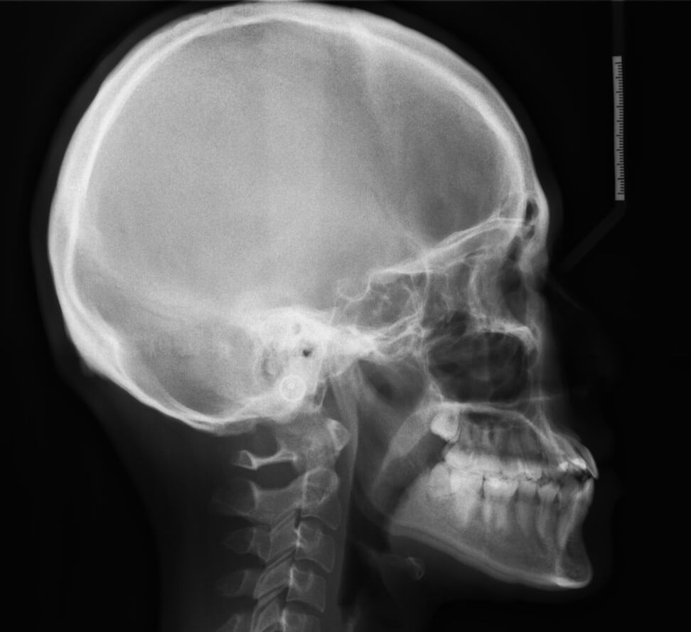 牙齒矯正前側顱照