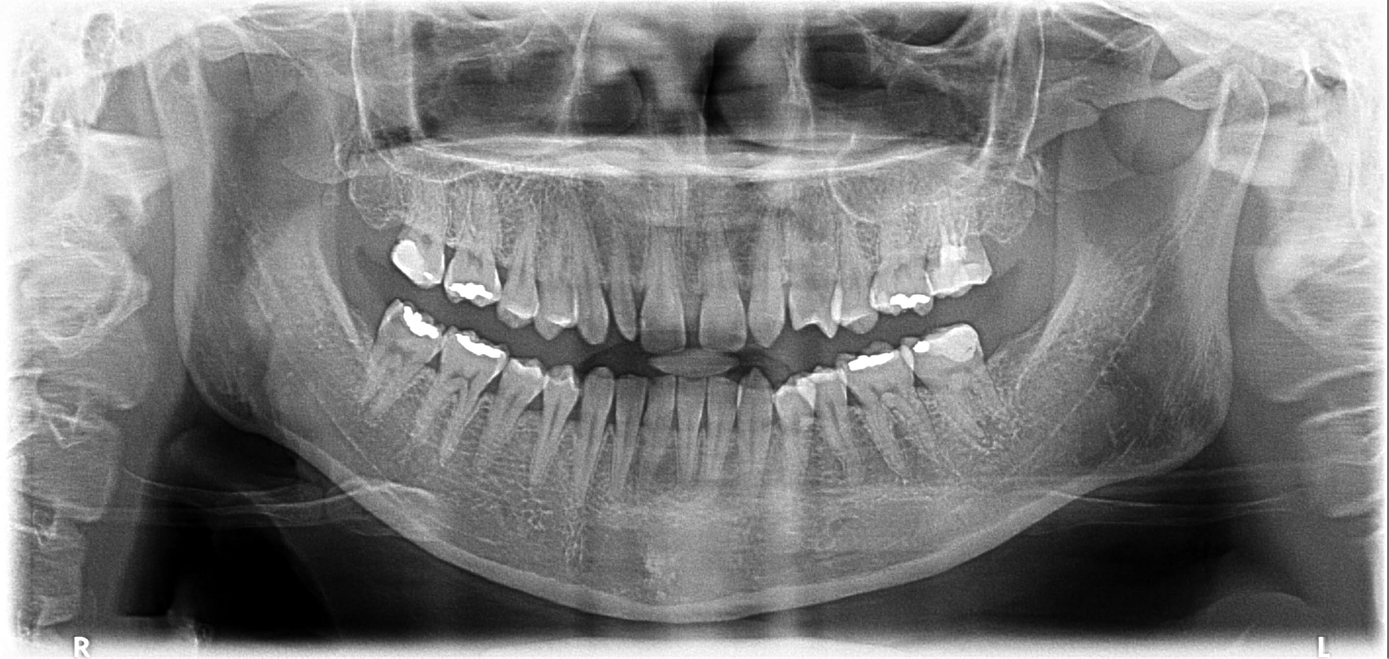 牙齒矯正前全口X光片