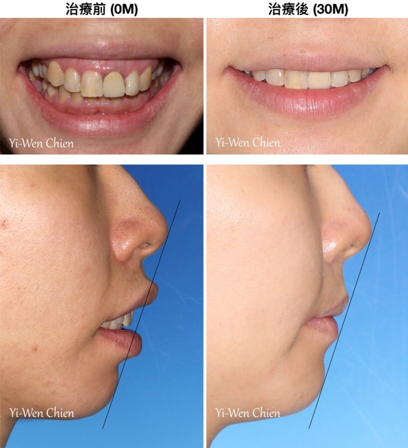 牙齒矯正前後矯正拍照紀錄