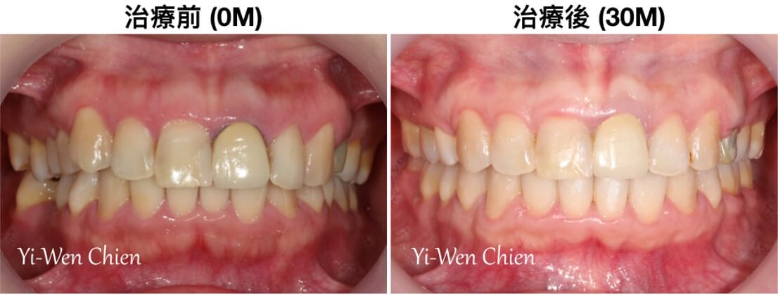牙齒矯正前後口內照對比