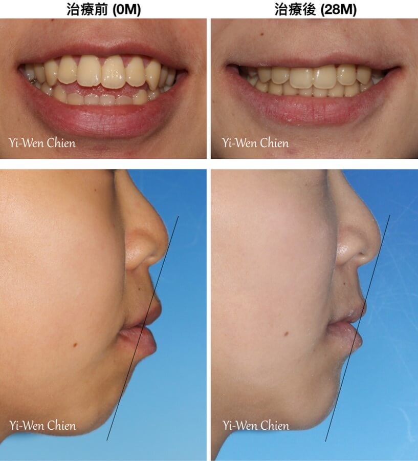 開咬的牙齒矯正前後口外照片