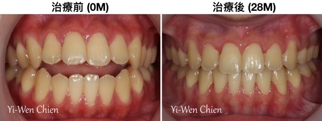 開咬牙齒矯正口內照
