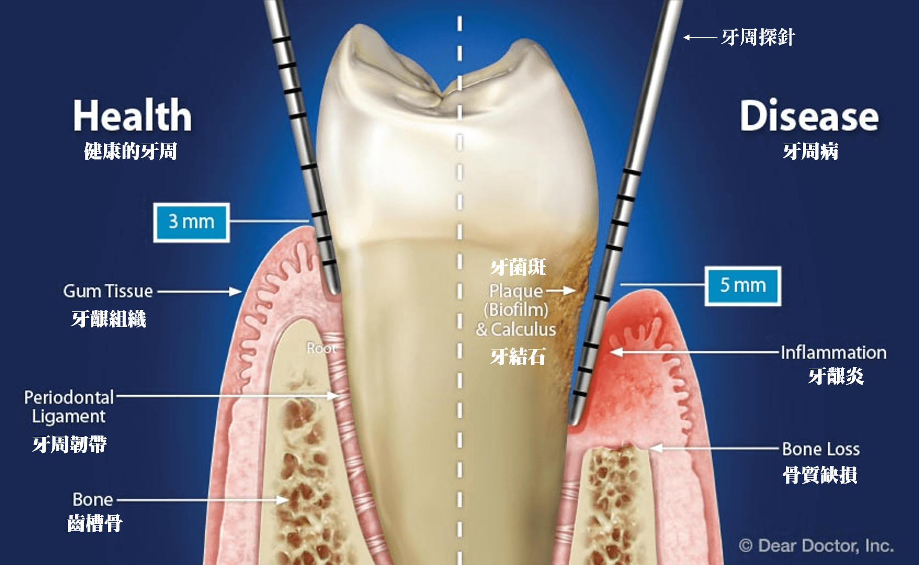 健康的牙周與牙周病示意圖