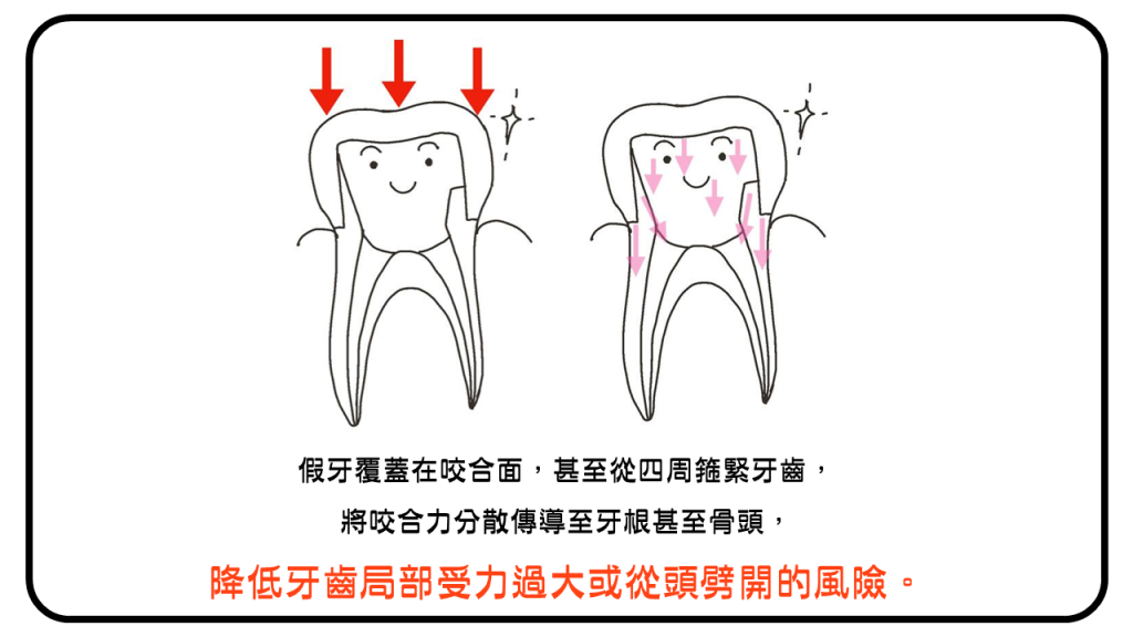 假牙從四周箍緊牙齒