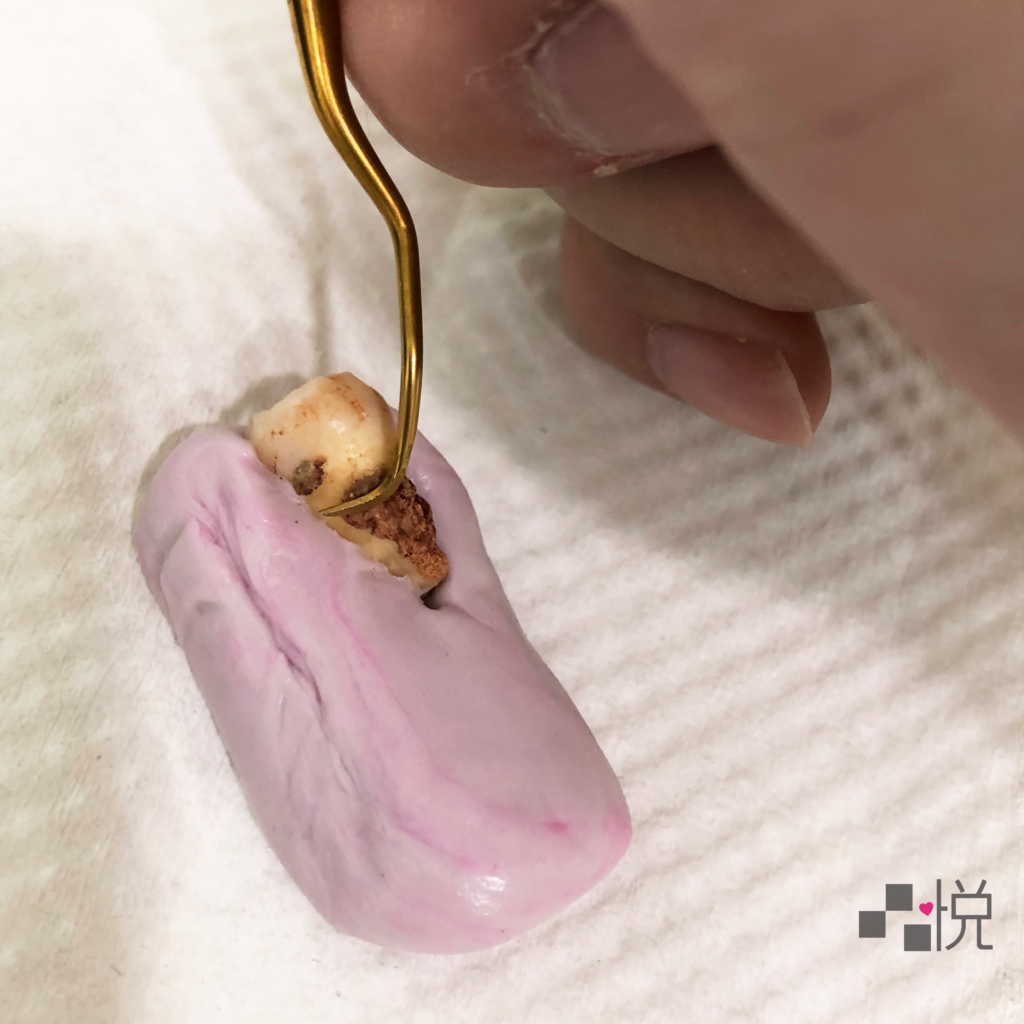 因為牙周刮刀器械頭較大無法全面深入牙齦下方刮除 牙結石