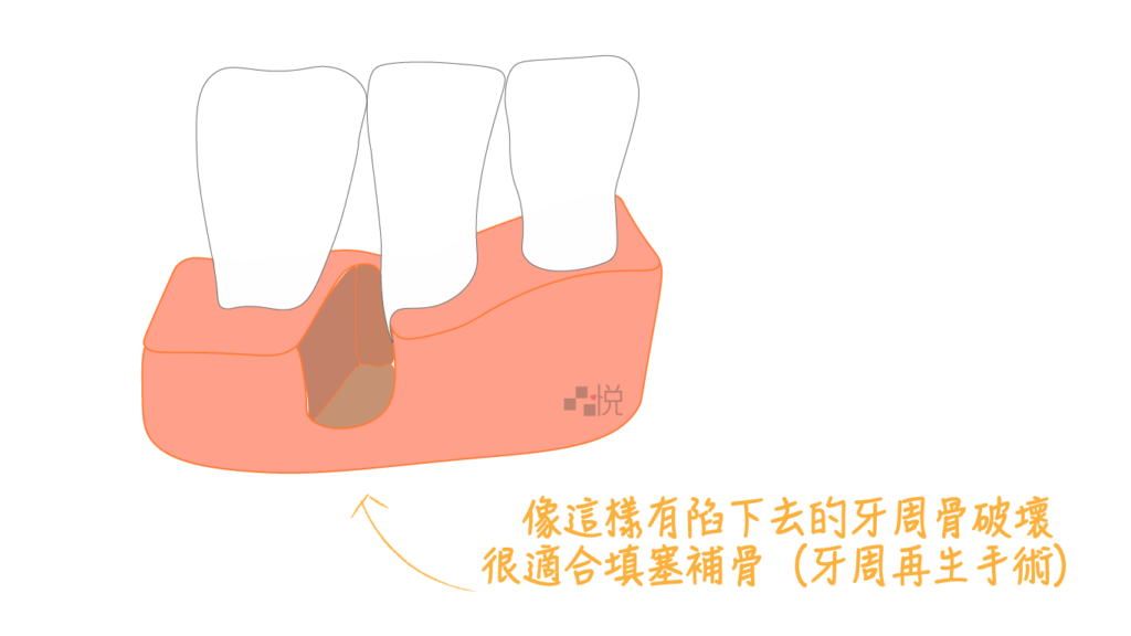 適合牙周再生補骨的牙周病缺損