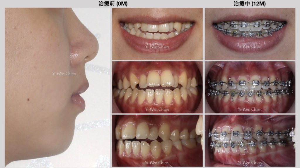 牙齒矯正治療齒列擁擠咬不起來前後比較圖
