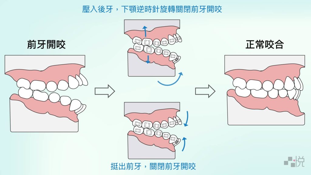 前牙開咬壓入前後牙的方式