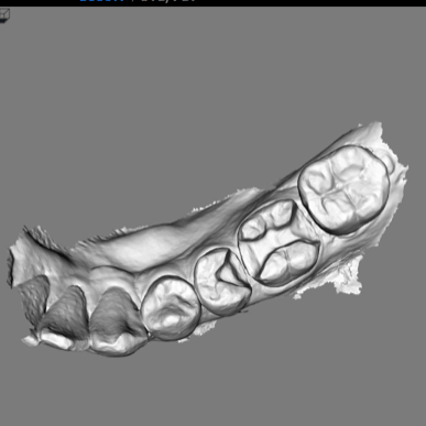 竹北牙醫口掃機掃描臼齒