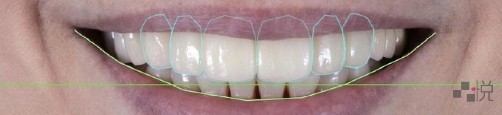 數位微笑設計下的量齒