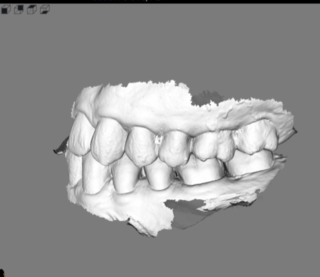 竹北牙醫數位口掃機掃描口腔閉合的牙齒狀態