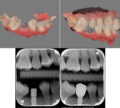 口掃機掃描植牙前後照