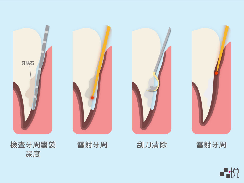 牙周雷射步驟圖