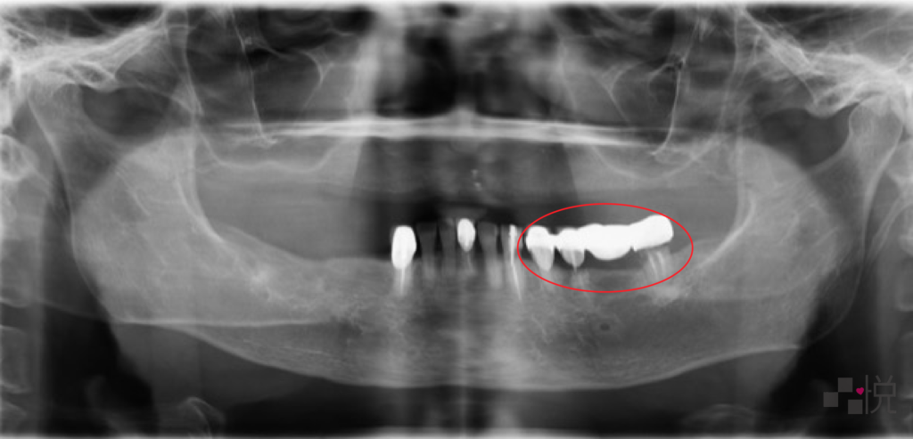 下顎牙橋下方蛀牙的Ｘ光片