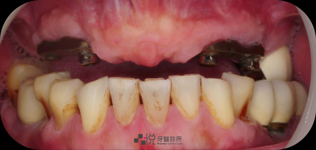 ao4術前(本來上顎是活動式假牙)