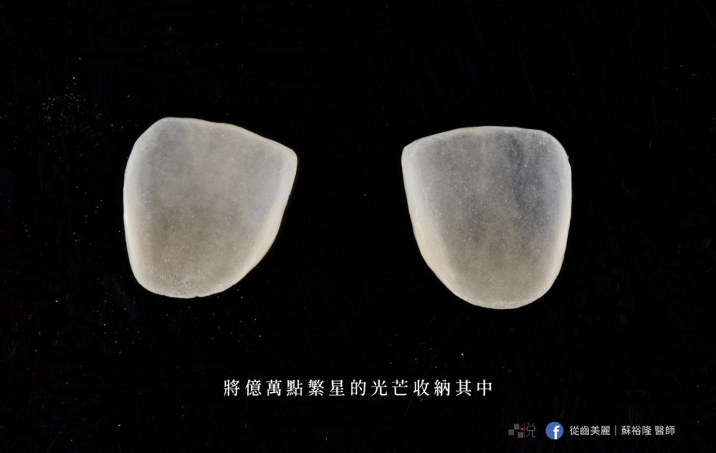 竹北品悅牙醫美白貼片實拍