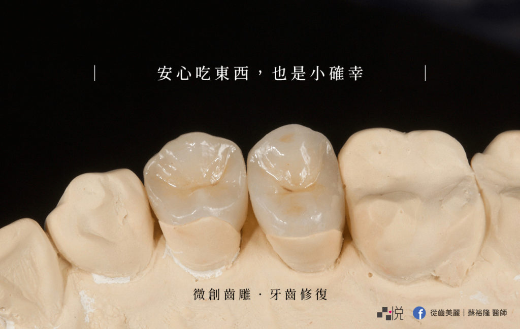 竹北品悅牙醫的齒雕實拍