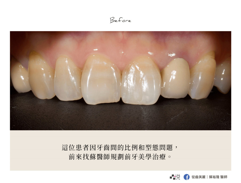 舊假牙使牙齦微微發黑