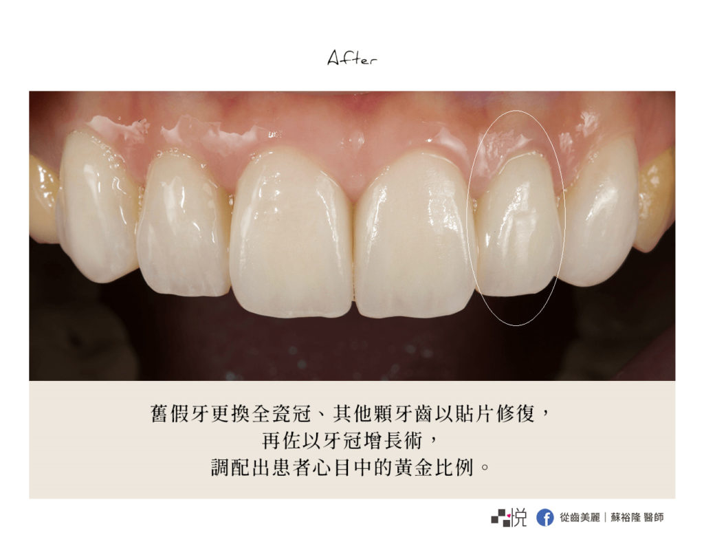 裝上全瓷冠和美白貼片後