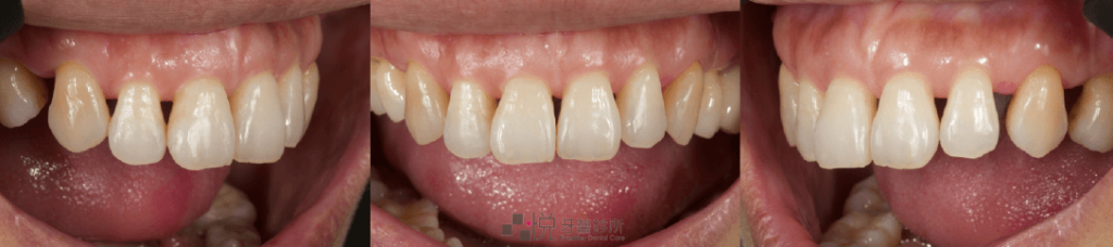 牙縫黑三角的三個角度