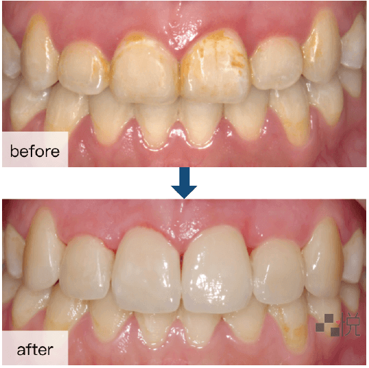 新竹陶瓷貼片美白術前術後