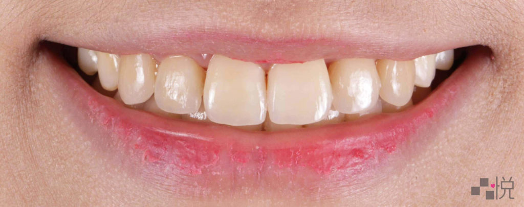 陶瓷貼片正式裝戴後AA2