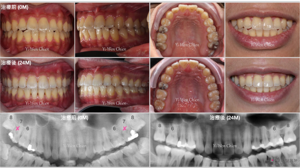智齒補缺牙案例一