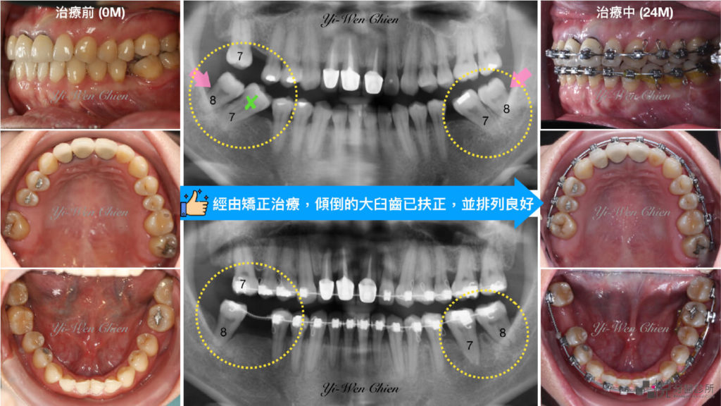 智齒補缺牙案例二