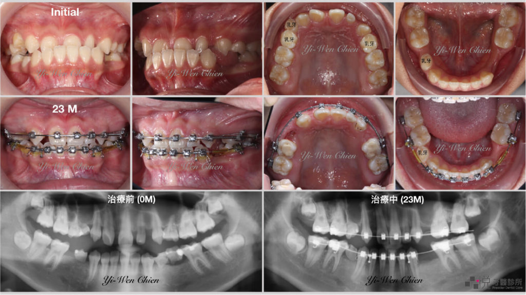傳統牙齒矯正補缺牙案例一