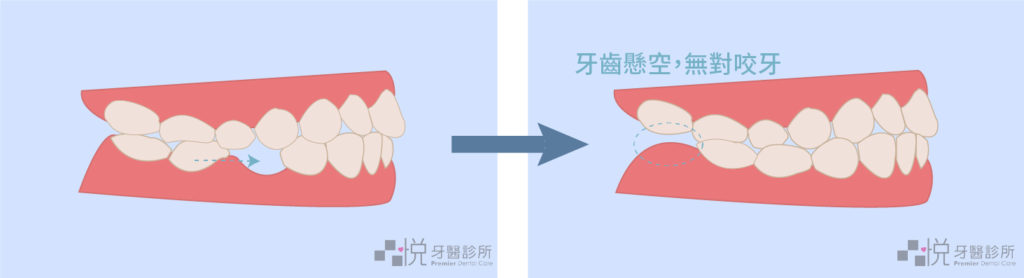 缺牙矯正有懸空的側面圖