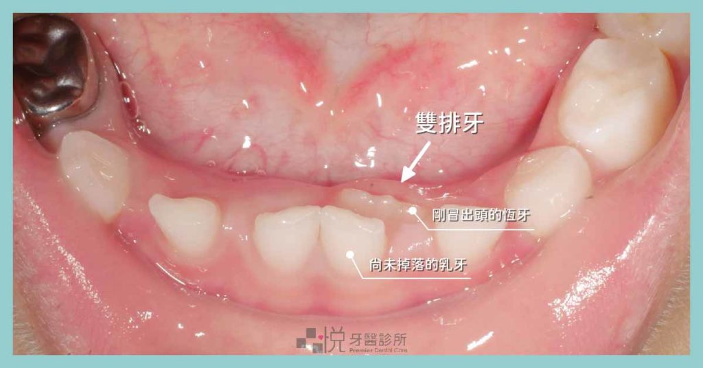 兒童乳牙換牙過渡期的雙排牙照片，乳牙掉不下來，恆牙長不出來