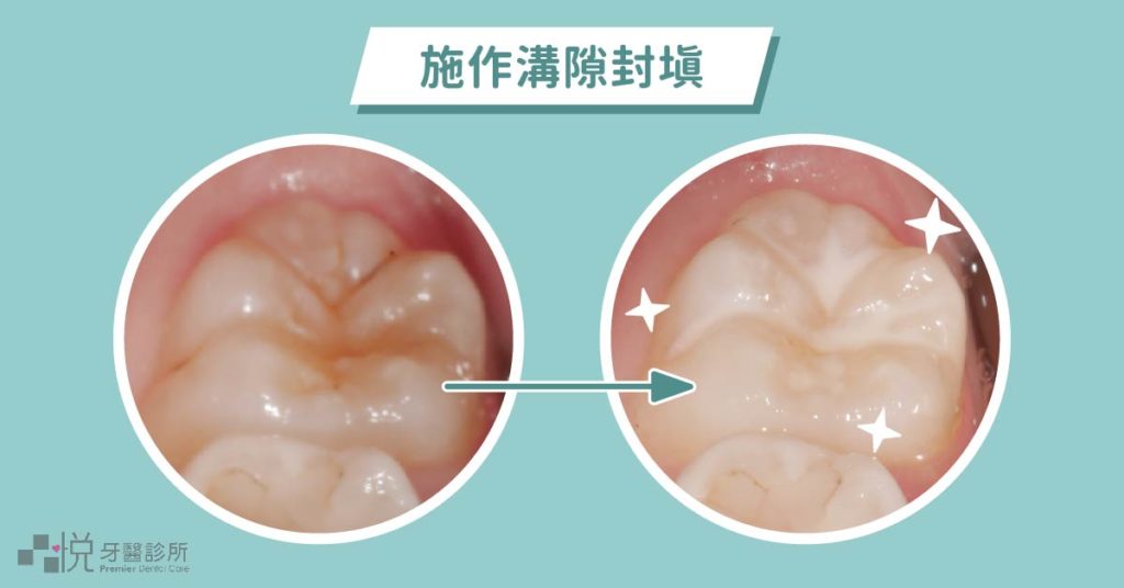 兒童換牙後施作溝隙封填
