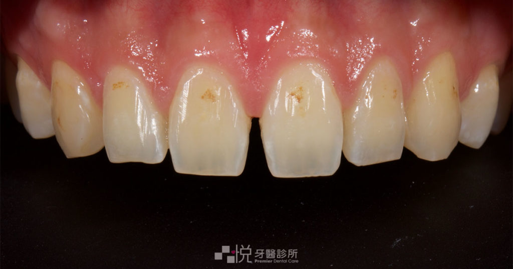 竹北陶瓷貼片磨牙前