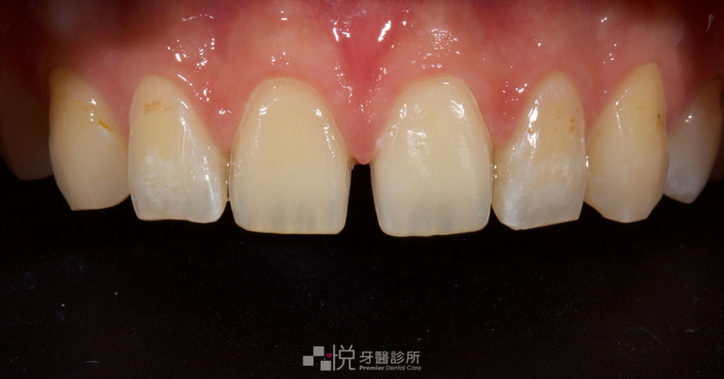 竹北陶瓷貼片微量磨牙後