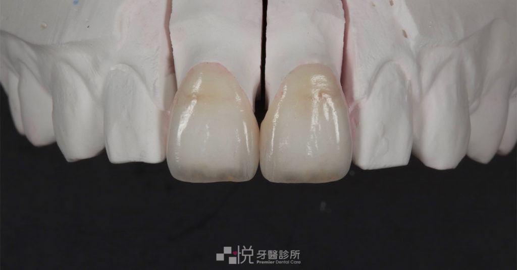 門牙陶瓷貼片試裝於石膏假牙上