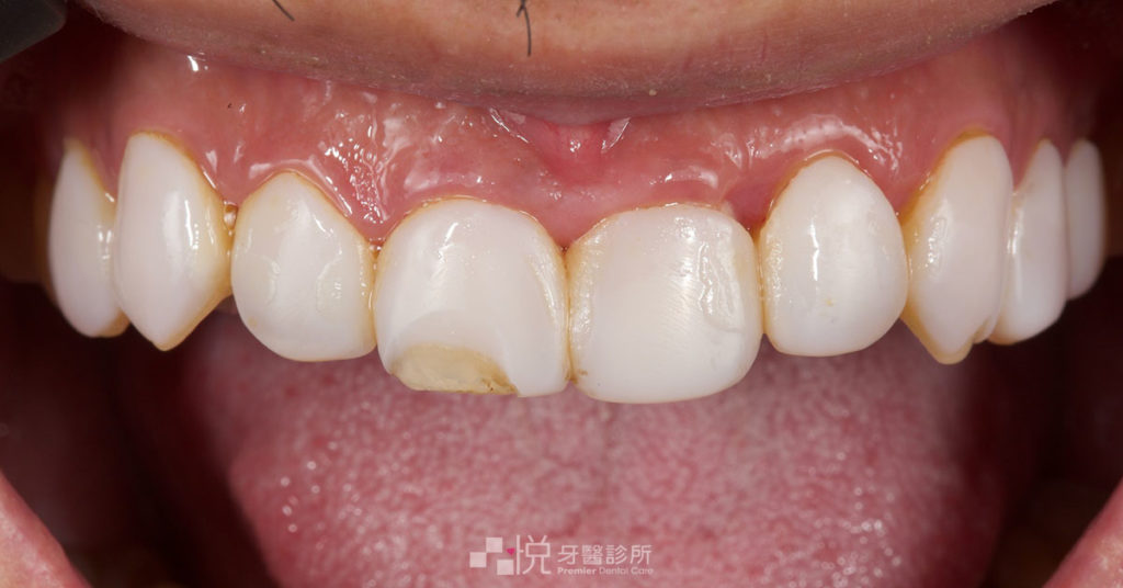 美齒店的奈米樹脂貼片