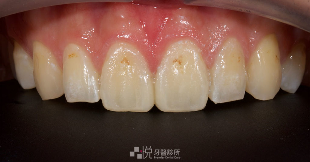裝陶瓷貼片前先裝臨時樹脂貼片