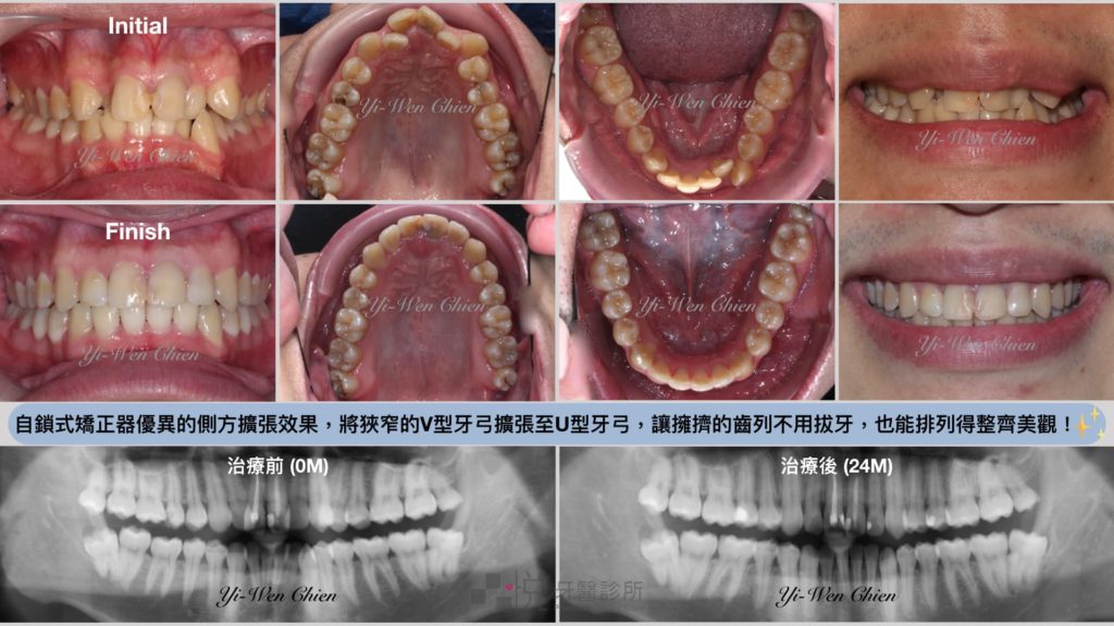 戴蒙矯正器治療後