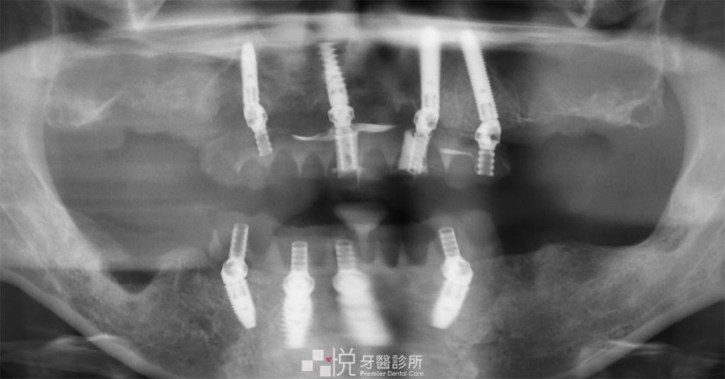 竹北張志嘉醫師執刀 All on 4手術後Ｘ光片