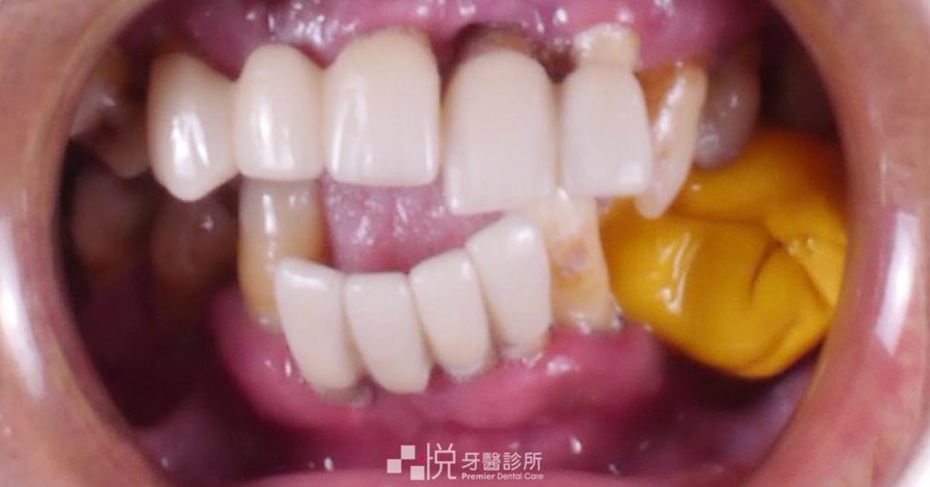 全口咬合跑位變形正面照片