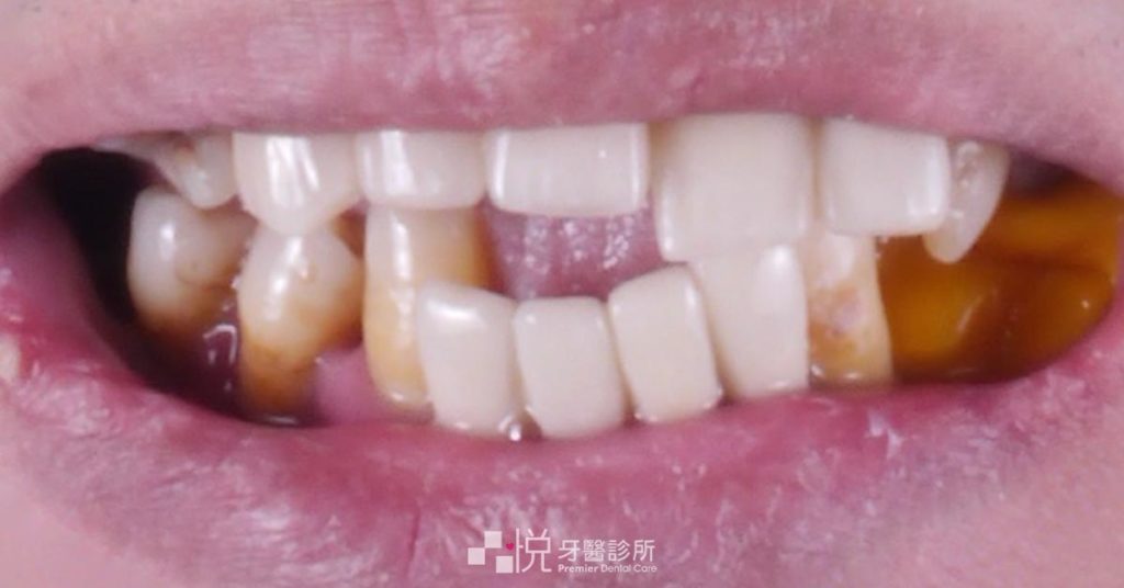 All on 4 手術前咬合不正