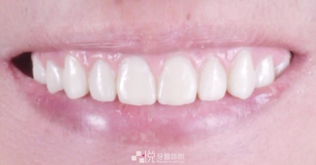All on 4 全口植牙手術後的笑容外觀
