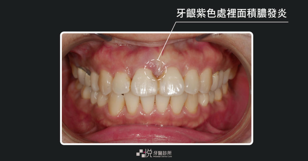 水雷射術前牙齦紫紫的