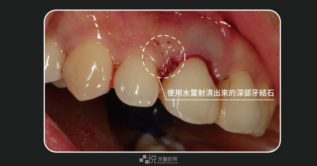 水雷射清出黑黑的深部牙結石