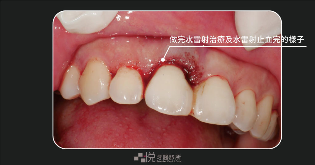 做完水雷射治療與止血的牙齦血塊