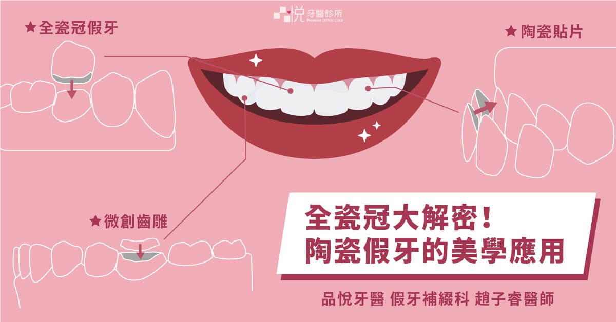 全瓷冠大解密！陶瓷假牙的美學應用：假牙、貼片、微創齒雕
