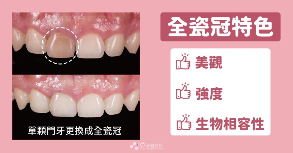 全瓷冠的特色：美觀、強度高、生物相容性高