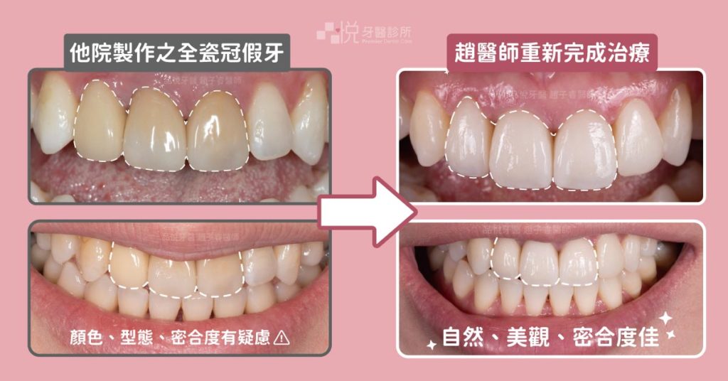 新竹品悅牙醫趙醫師重新治療他院之全瓷冠