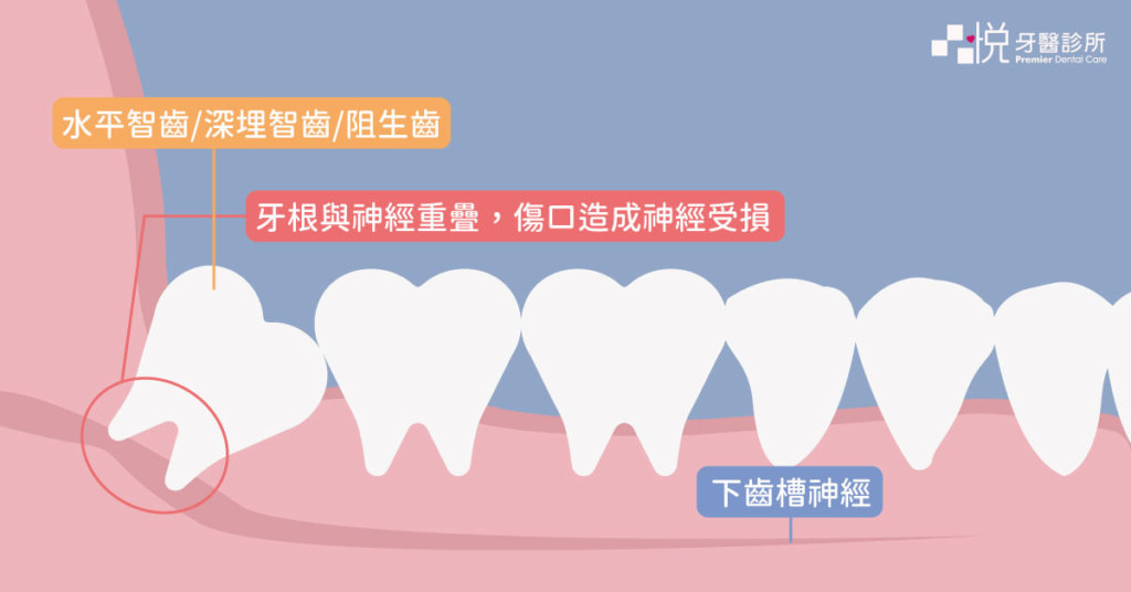 牙根與神經重疊，其傷口有小機率會引起神經受損。