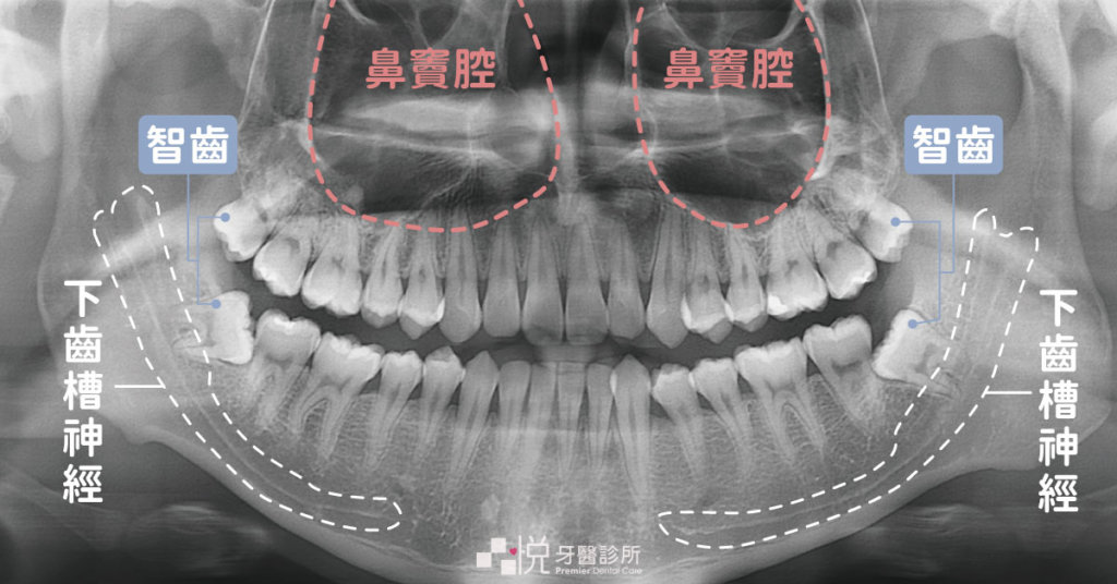 環口x光片
案例提供：品悅牙醫 黃莞婷醫師